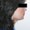 Submental Lipectomy and Neck Plasty