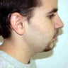 Submental Lipectomy and Neck Plasty