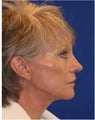 Necklift, Facelift, Laser Resurfacing