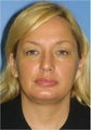 Necklift, Lower Blepharoplasty