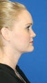 1 month post op: Necklift & Neck Liposuction