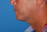 Weekend Neck Lift