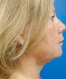 Neck Liposuction