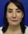 Neck Liposcution