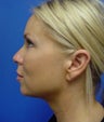 Neck Liposuction