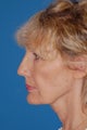 Neck Lift
