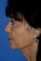 Neck Lift