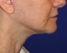 Neck lift surgery