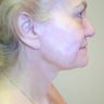 Neck Lift