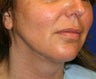 Neck Liposuction