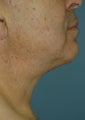 Neck Lift