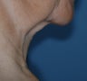 Neck Lift