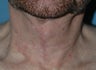 Neck Lift