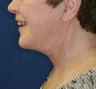 Facelift, Necklift