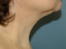 Neck Lift