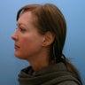 Neck Lift