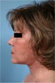 Neck lift