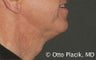 Cervicoplasty