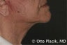 Cervicoplasty