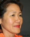Neck Lift