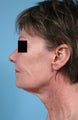 Neck Lift