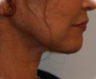 Face lift and Neck Lift