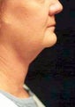 Neck Lift