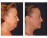 Face & Neck Lift with Fat Grafting