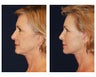 Neck Lift