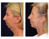 Neck Lift