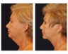 Neck Lift