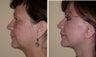 Necklift