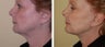 Necklift
