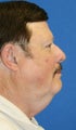 Neck Lift