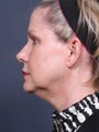 Neck Lift