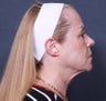 Neck Lift
