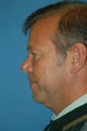 Necklift