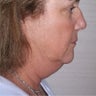 Neck Lift