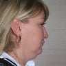 Neck Lift