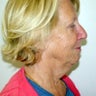 Neck Lift