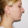 Submental Lipectomy and Neck Plasty