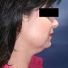 Submental Lipectomy and Neck Plasty
