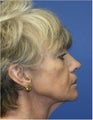 Necklift, Facelift, Laser Resurfacing