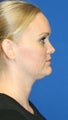 1 month post op: Necklift & Neck Liposuction