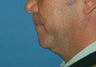 Weekend Neck Lift