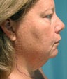 Neck Liposuction