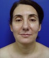 Neck Liposcution