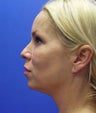 Neck Liposuction