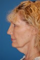 Neck Lift