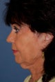 Neck Lift